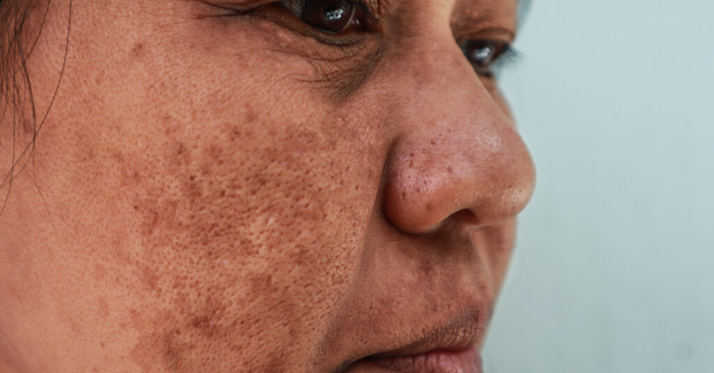 Hyperpigmentation On The Forehead? Know The Causes And The Solution