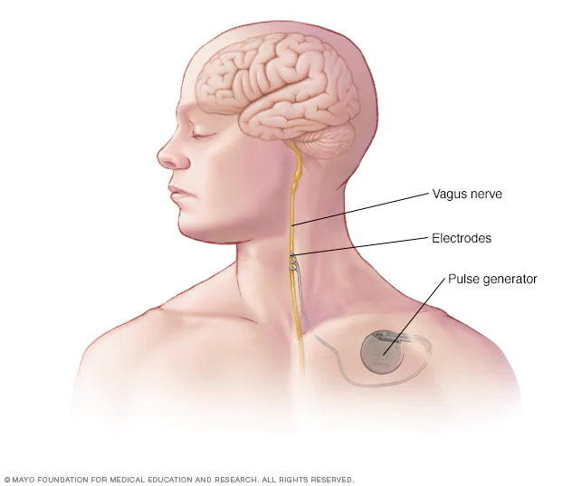 vagus nerve irritation symptoms