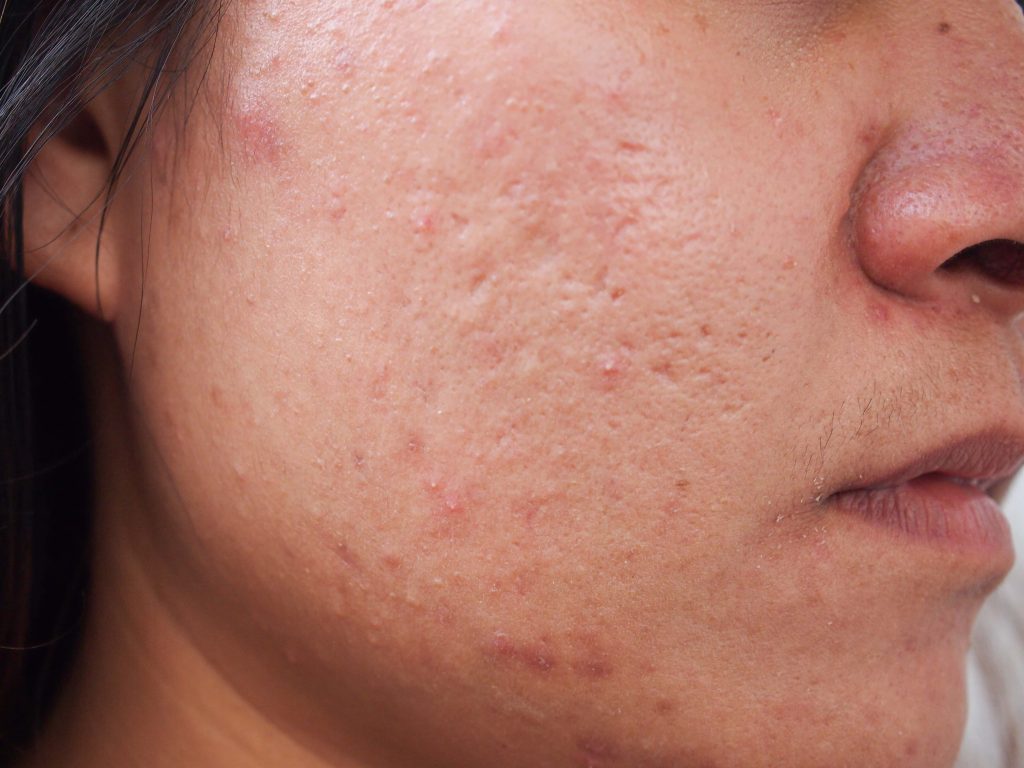 How to cure acne scars using Dermarollers?